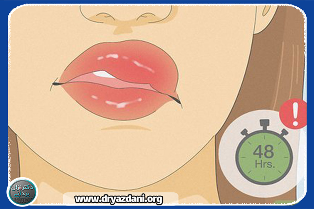 چگونه از گلوله گشتن و به حرکت درآوردن ژل جلوگیری کنیم‌؟
