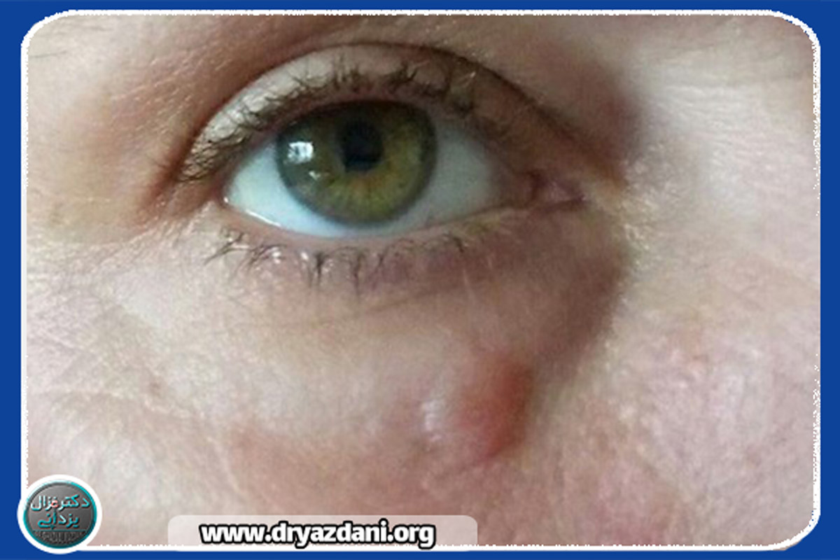 علت گلوله گشتن ژل لب هیالورونیک اسید چیست؟